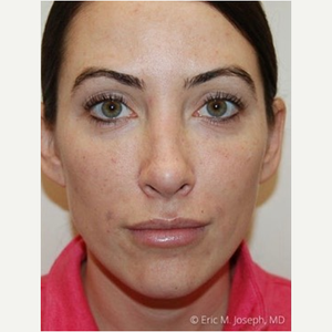 Eric M. Joseph, MD  Non-Surgical Nose Job Information Dr. Eric M. Joseph