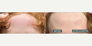 retatrutide with tirzepatide I'm getting asked about Retatrutide vs Tirzepatide. Which is better? Since tirzepatide (Mounjaro) has a longer clinical record and is FDA approved for weight loss and type 2 diabetes; Clear track of