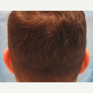 Michael Wolfeld Md Reviews Before And After Photos Answers Realself