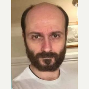Serkan Aygin Md Reviews Before And After Photos Answers Realself