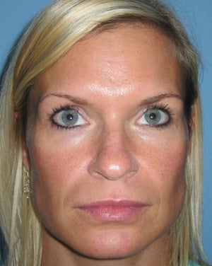 Michael Vennemeyer Md Reviews Before And After Photos Answers Realself