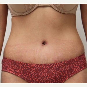 Don't Be Scared of Your Tummy Tuck Scar – Josh Olson, MD