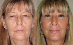 Richard Castellano Md Reviews Before And After Photos Answers Realself