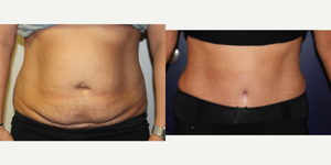 Algie LaBrasca, DO, Board Certified Plastic Surgeon | Real Patient Reviews, Before & After Photos, Expert Answers