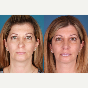 Botox and Fillers Before and Afters, Raval Facial Aesthetics