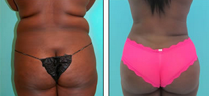 Dr. Miami on X: Whatcha guys think of my patient's tummy tuck?   / X