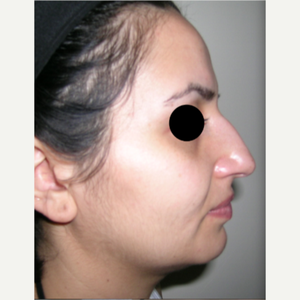 Alper Tuncel Md Reviews Before And After Photos Answers Realself
