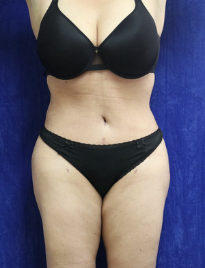 BBL aka #Liposuction and - Matthew J Nykiel MD