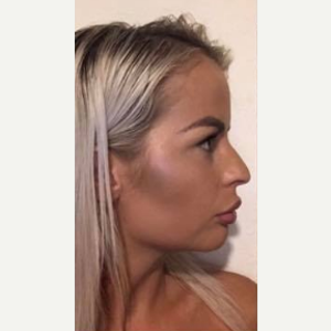 Hakan Gence Md Reviews Before And After Photos Answers Realself