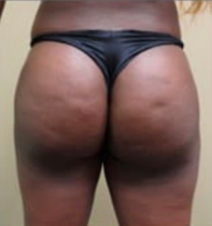 Tummy Tuck Before & After - Ary Krau MD