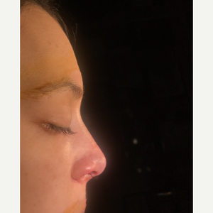 Oakley Smith Md Frcsc Reviews Before And After Photos Answers Realself Oakley smith toronto rhinoplasty surgery's profile is incomplete. oakley smith md frcsc reviews before