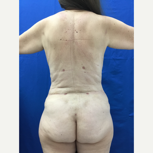 Karl William Schwarz Md Reviews Before And After Photos Answers Realself