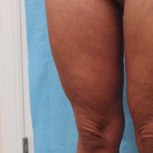 Didn't wear compression garment after thigh liposuction. Now I have sagging  skin. Would coolsculpting or a laser help? (Photo)
