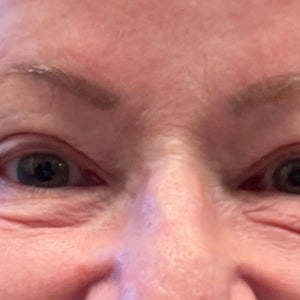 Under eye wrinkles How can this be addressed photos