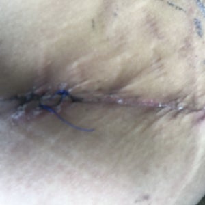 Love my TT hate my inner thigh Lipo. Why are my inner thighs wicked hard  and crepey? (Photos)
