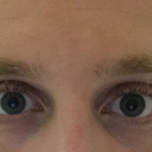 hereditary dark circles laser treatment
