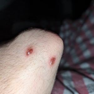 How do I heal a chemical burn scar with warts in it? (photo)