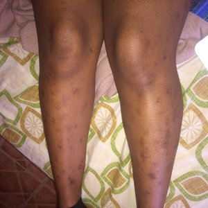 can glutathione remove leg scars What I do to my scars? (Photo) category-amino-acids