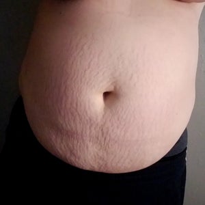 laser lipo after c-section Would laser Lipo work for me or is it a waste of money? (Photos)