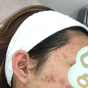 iud and accutane