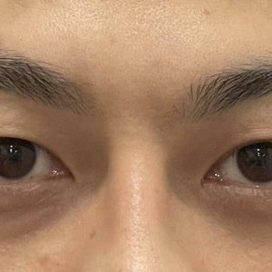 Double Eyelid Surgery Reviews Was it Worth It RealSelf