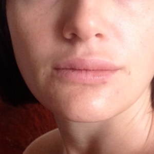 I got lipofilling in my lips, to make them a LITTLE bigger. Is there anyway  to UNDO this? Taking out the fat? (Photo)