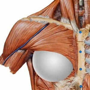 Animation deformity seen with the submuscular or dual-plane