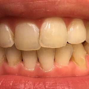 Stains Between Teeth Removal . How Can I Get Rid Of The Brown Stains Between My Teeth Photos