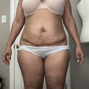 lipo c section shelf What are the best C section shelf treatment options for me? (Photos)