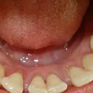 How May I Able To Get Rid Of Brown Spots On The Back Of My Front Teeth Photos