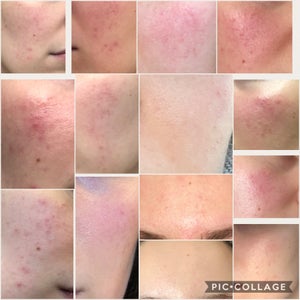 soolantra before after