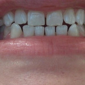Will Invisalign Help with my End to End Bite?
