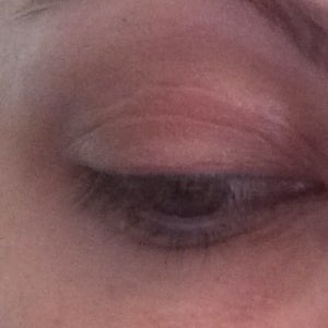 double crease eyelid