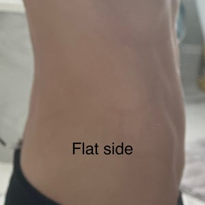 I have a small pocket that is soft and is not adhered to a C-section scar. Can this area have lipo? (Photos) I have a small pocket that is soft and is not adhered to a C-section scar. Can this area have lipo? (Photos)