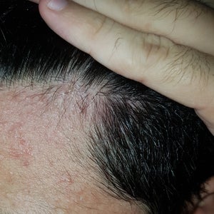 Can Minoxidil Be Used For A Receding Hairline And Beard Photos This may need to be done a couple of times a day. receding hairline and beard photos
