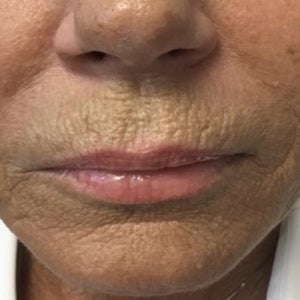 Fractional Laser Reviews Was It Worth It Realself