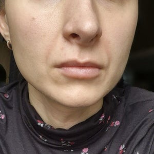 Nasolabial folds with pigmentation (photo)