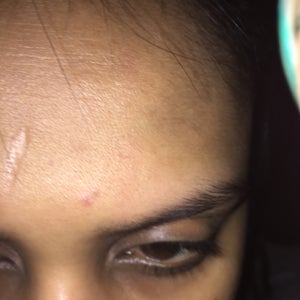 What Can I Do To Get Rid Of A Big Dent On My Forehead Photos