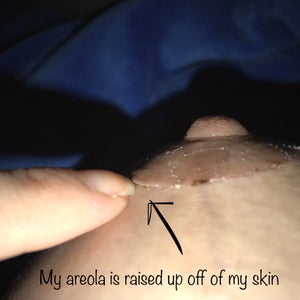 Why are my areolas different from each other in shape and raised up off my  skin where the incisions were made? (Photos)