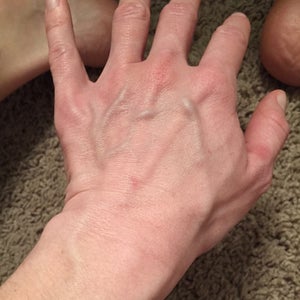 large veins in hands