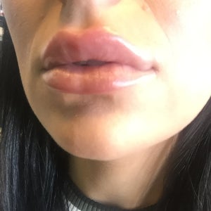 Numbness And Hardness 3 Days After Juvederm Filler In Lips Photo