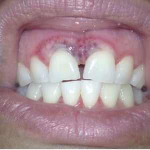 Zoom whitening chemical burns on my gums. How long until it heals