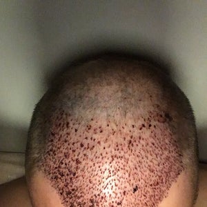 22 Year Old, Just Had an FUE transplant with PRP. Didn't completely quit chewing  tobacco, will it effect my grafts? (photo)
