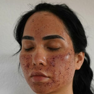 Fraxel Laser Reviews Was It Worth It Realself