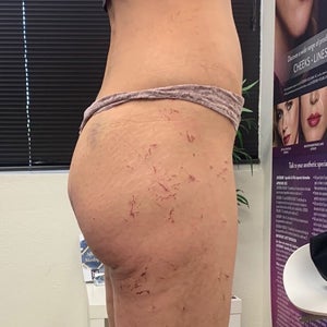 Tighten loose thigh new arrivals skin