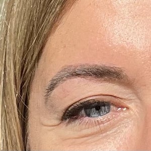 What is the best procedure for my under eye wrinkles photo