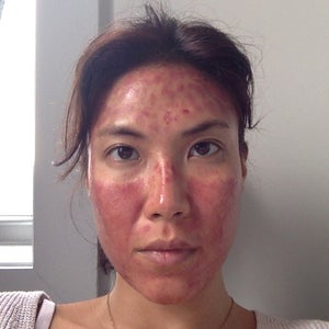 Dermapen Reviews Was It Worth It Realself
