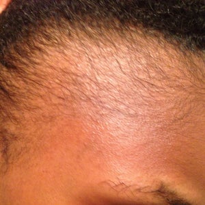 Would Cortisone Injections Be An Option For My Hair Loss Or Is Hair Transplant Surgery The Only Option Photos