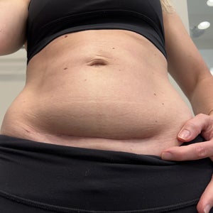 can you get lipo during c section Tummy Tuck After C-Section in Manchester main image 0
