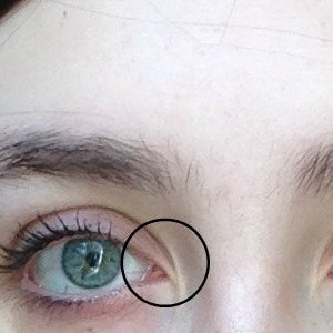 How Much Would It Cost To Remove Or Minimize The Extra Skin By My Eye Photo